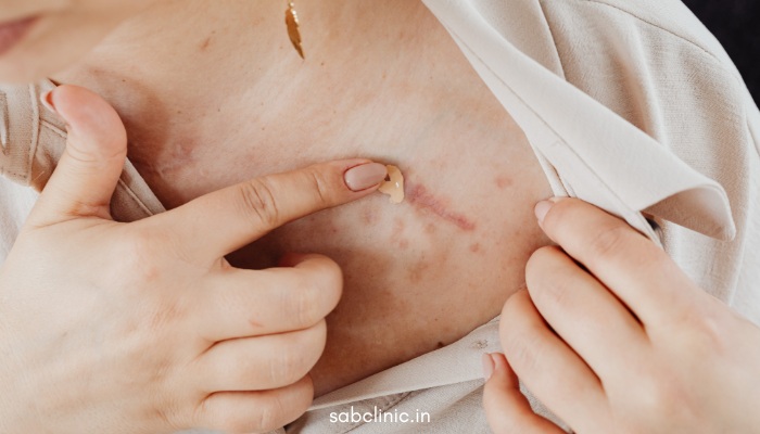 Acne Scars MNRF Treatment