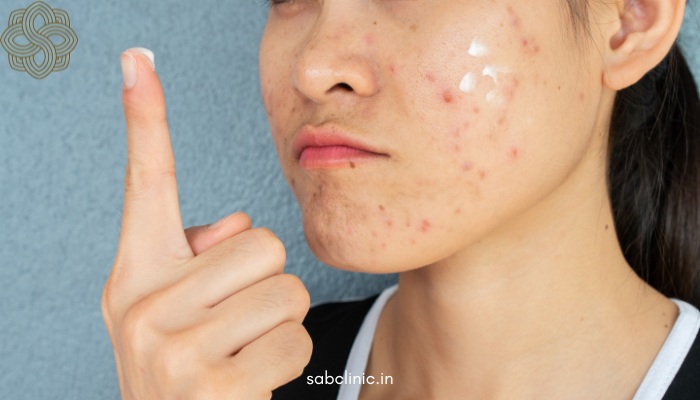 Skin Problems in Delhi