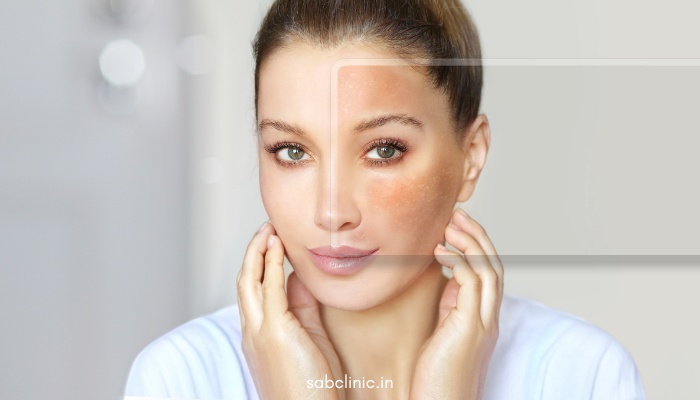 Skin Problems on Daily Life