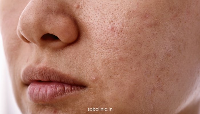 Top 10 Skin Problems in Delhi