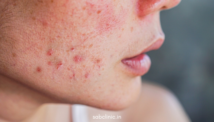 acne scar treatment