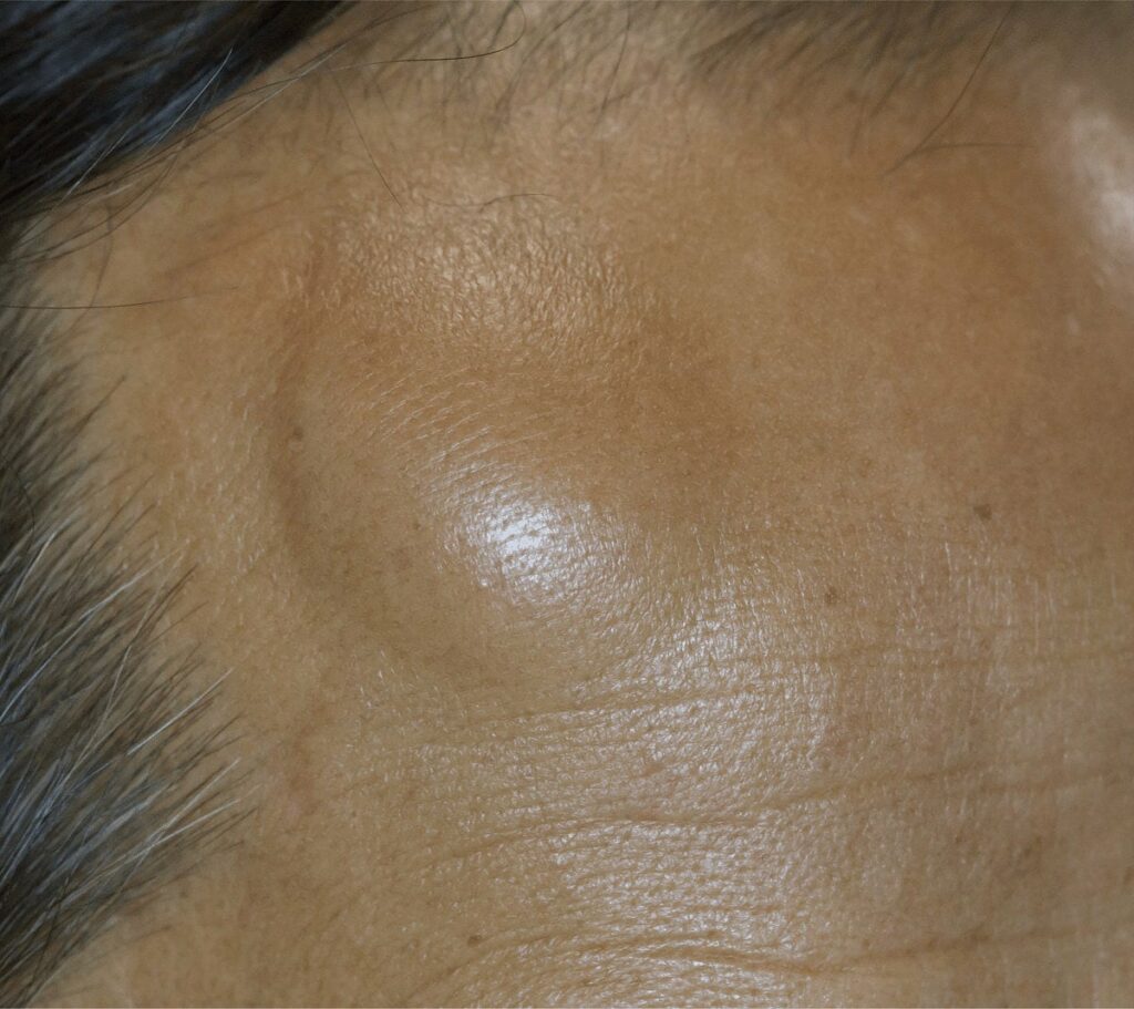 Cyst & Lipoma Removal