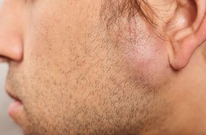 Cyst & Lipoma Removal