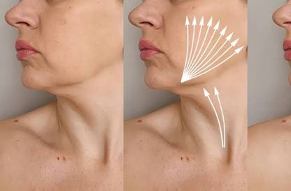Double Chin Treatment