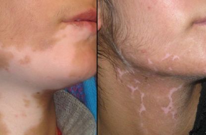Vitiligo Surgery