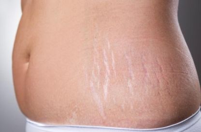 Stretch Marks Treatment