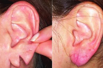 Ear Lobe Repair