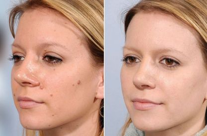 Mole Removal