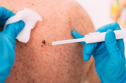 Skin Tags Removal