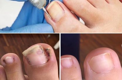Nail Surgery