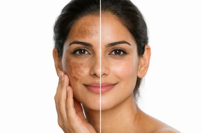 Pigmentation Treatment