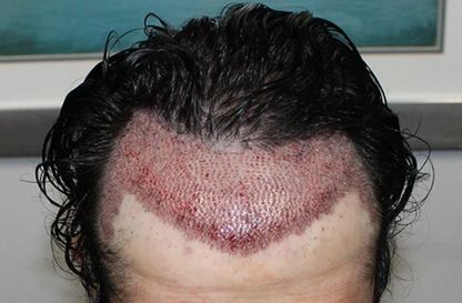 Hair Transplant